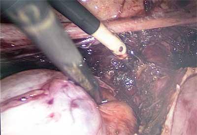 Scientific Advances for Minimally Invasive Surgery in Gynaecology
